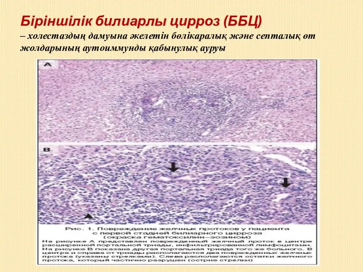 Біріншілік билиарлы цирроз (ББЦ) – холестаздың дамуына әкелетін бөлікаралық және септалық өт жолдарының аутоиммунды қабынулық ауруы