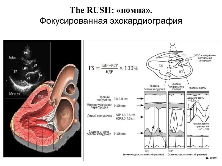 The RUSH: «помпа». Фокусированная эхокардиография