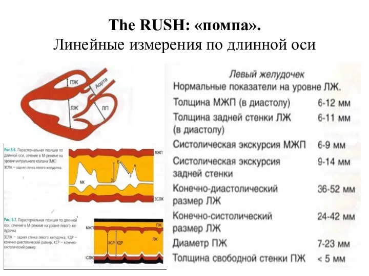 The RUSH: «помпа». Линейные измерения по длинной оси