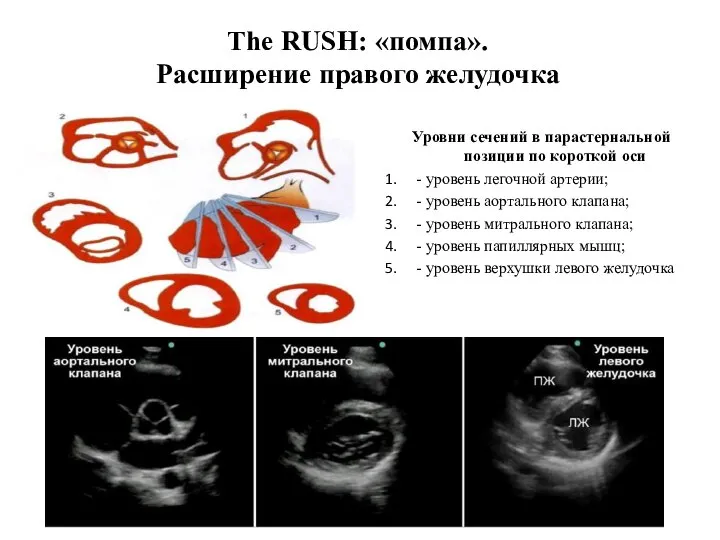 The RUSH: «помпа». Расширение правого желудочка Уровни сечений в парастернальной позиции по