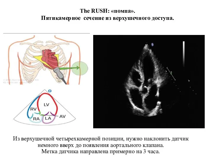 The RUSH: «помпа». Пятикамерное сечение из верхушечного доступа. Из верхушечной четырехкамерной позиции,