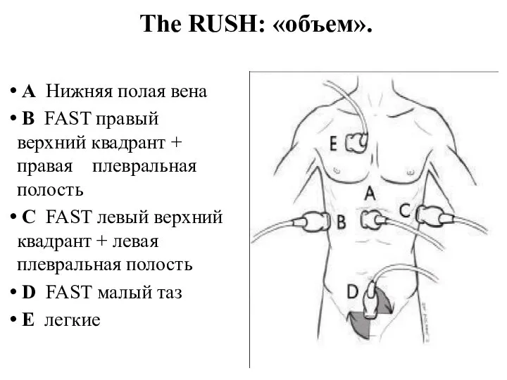 А Нижняя полая вена В FAST правый верхний квадрант + правая плевральная
