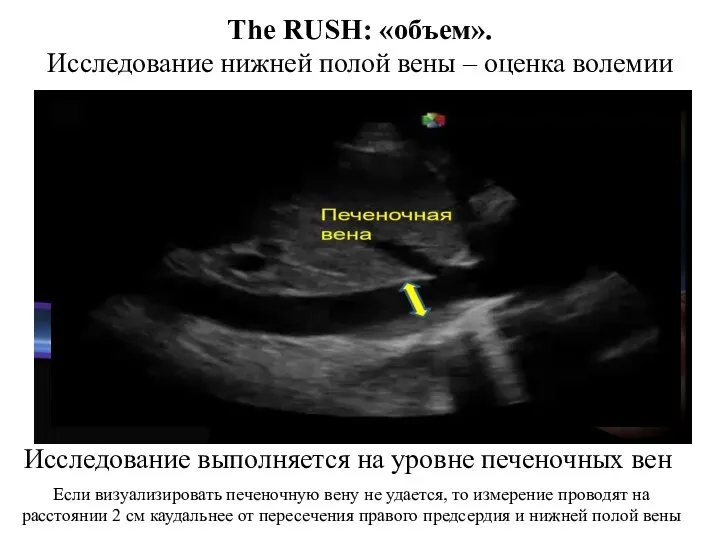 The RUSH: «объем». Исследование нижней полой вены – оценка волемии Если визуализировать