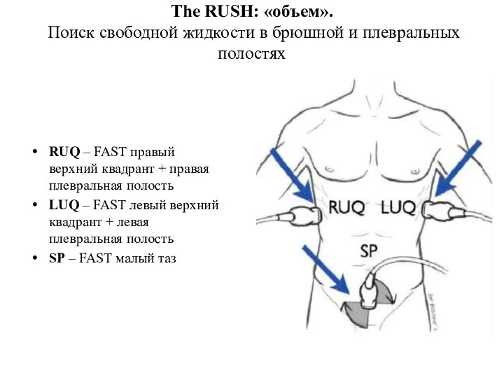 RUQ – FAST правый верхний квадрант + правая плевральная полость LUQ –