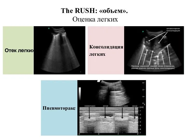 Отек легких Консолидация легких The RUSH: «объем». Оценка легких Пневмоторакс