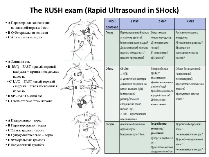 The RUSH exam (Rapid Ultrasound in SHock) А Парастернальная позиция по длинной/короткой
