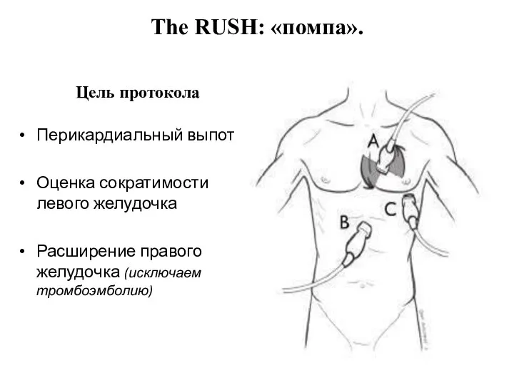The RUSH: «помпа». Цель протокола Перикардиальный выпот Оценка сократимости левого желудочка Расширение правого желудочка (исключаем тромбоэмболию)