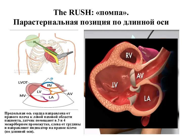 Продольная ось сердца направлена от правого плеча к левой паховой области пациента,