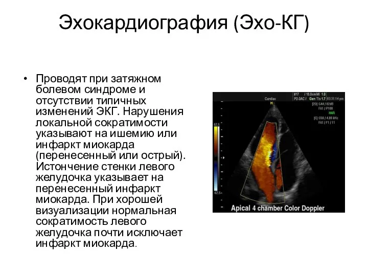 Эхокардиография (Эхо-КГ) Проводят при затяжном болевом синдроме и отсутствии типичных изменений ЭКГ.