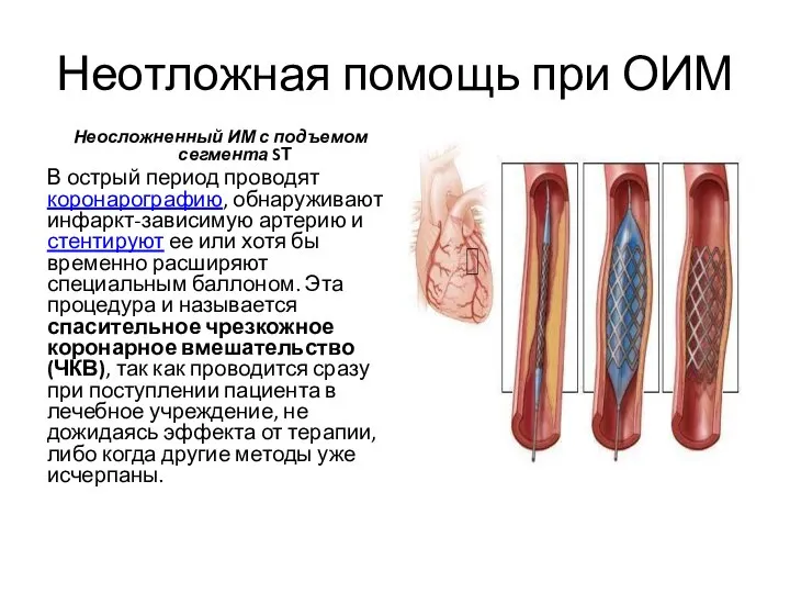 Неотложная помощь при ОИМ Неосложненный ИМ с подъемом сегмента SТ В острый