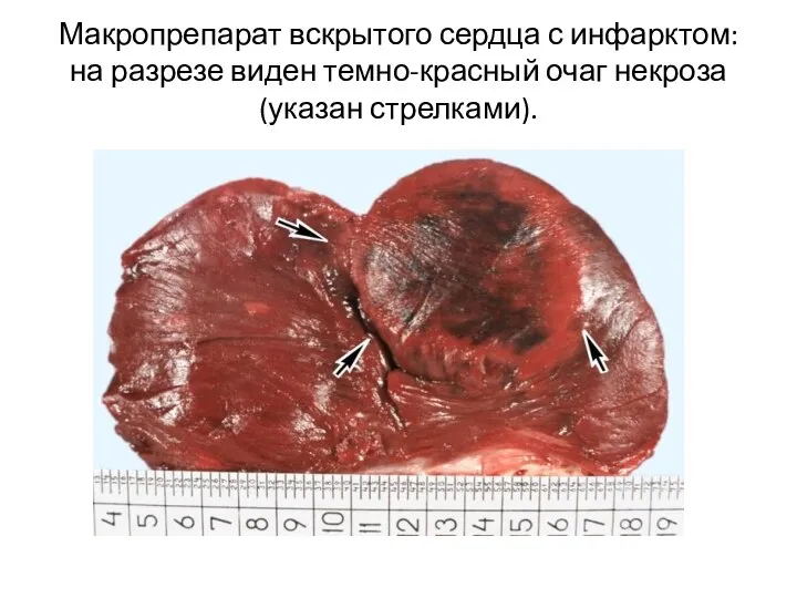 Макропрепарат вскрытого сердца с инфарктом: на разрезе виден темно-красный очаг некроза (указан стрелками).