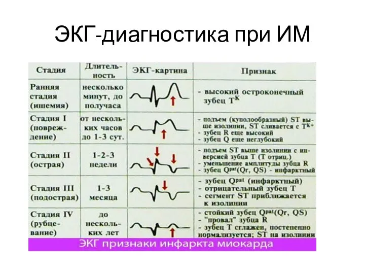 ЭКГ-диагностика при ИМ