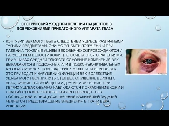 1. СЕСТРИНСКИЙ УХОД ПРИ ЛЕЧЕНИИ ПАЦИЕНТОВ С ПОВРЕЖДЕНИЯМИ ПРИДАТОЧНОГО АППАРАТА ГЛАЗА КОНТУЗИИ