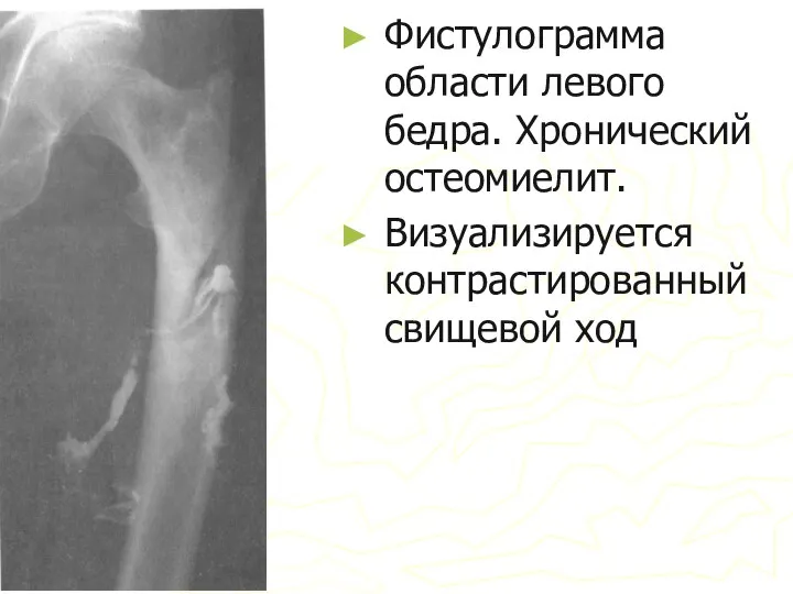 Фистулограмма области левого бедра. Хронический остеомиелит. Визуализируется контрастированный свищевой ход