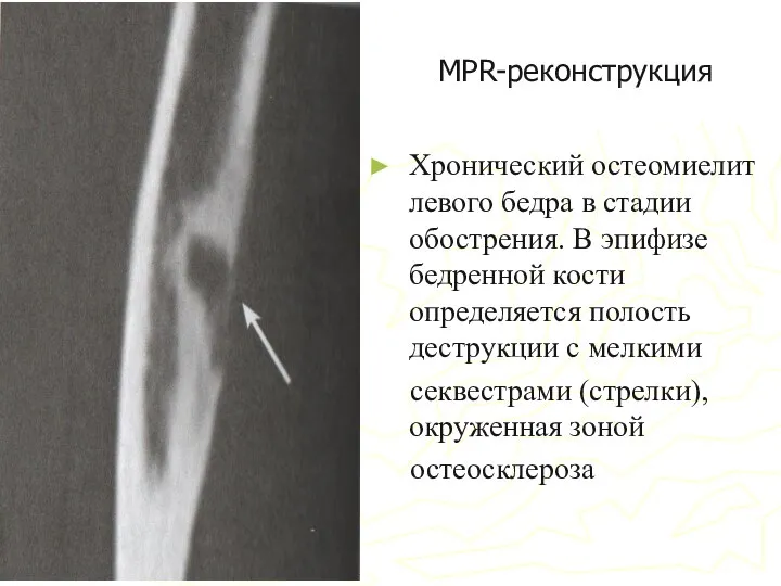 MPR-реконструкция Хронический остеомиелит левого бедра в стадии обострения. В эпифизе бедренной кости