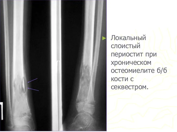 Локальный слоистый периостит при хроническом остеомиелите б/б кости с секвестром.