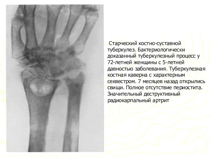 Старческий костно-суставной туберкулез. Бактериологически доказанный туберкулезный процесс у 72-летней женщины с 5-летней