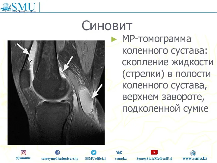 Синовит МР-томограмма коленного сустава: скопление жидкости (стрелки) в полости коленного сустава, верхнем