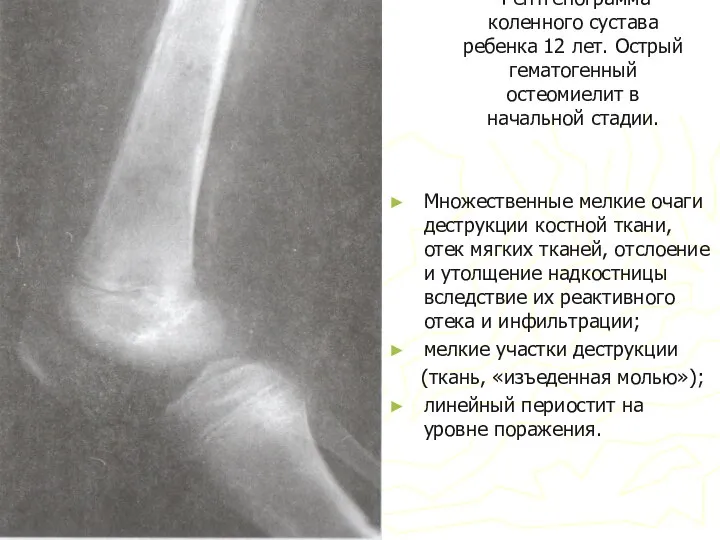 Рентгенограмма коленного сустава ребенка 12 лет. Острый гематогенный остеомиелит в начальной стадии.