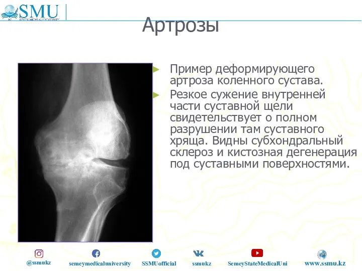 Артрозы Пример деформирующего артроза коленного сустава. Резкое сужение внутренней части суставной щели