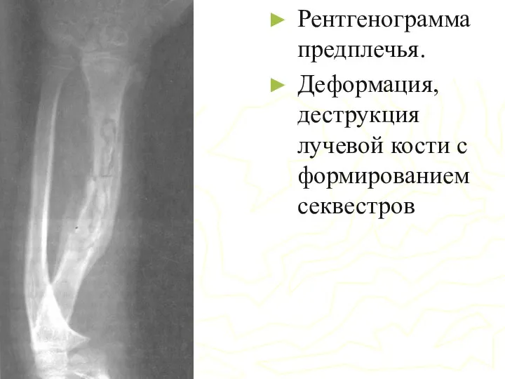 Рентгенограмма предплечья. Деформация, деструкция лучевой кости с формированием секвестров