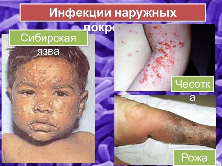 Сибирская язва Инфекции наружных покровов Рожа Чесотка