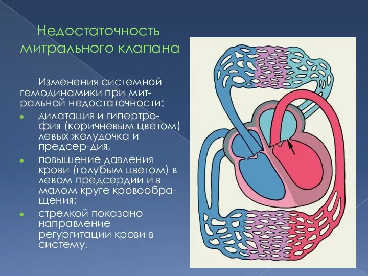 Недостаточность митрального клапана Изменения системной гемодинамики при мит-ральной недостаточности: дилатация и гипертро-фия