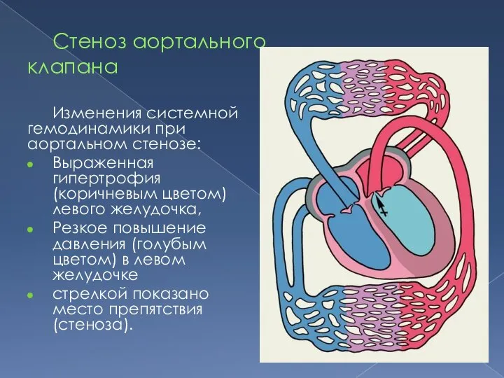Стеноз аортального клапана Изменения системной гемодинамики при аортальном стенозе: Выраженная гипертрофия (коричневым