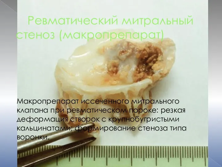Ревматический митральный стеноз (макропрепарат) Макропрепарат иссеченного митрального клапана при ревматическом пороке: резкая