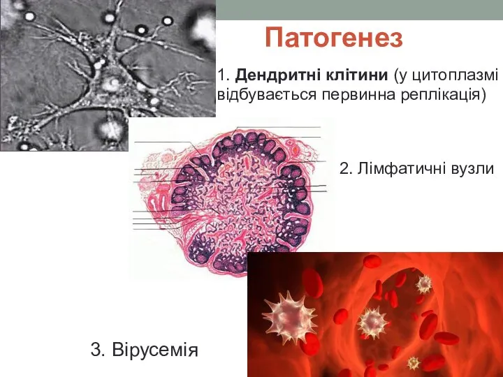 Патогенез 1. Дендритні клітини (у цитоплазмі відбувається первинна реплікація) 2. Лімфатичні вузли 3. Вірусемія