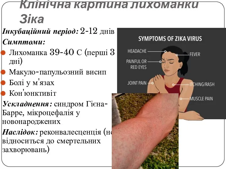 Клінічна картина лихоманки Зіка Інкубаційний період: 2-12 днів Симптоми: Лихоманка 39-40 С