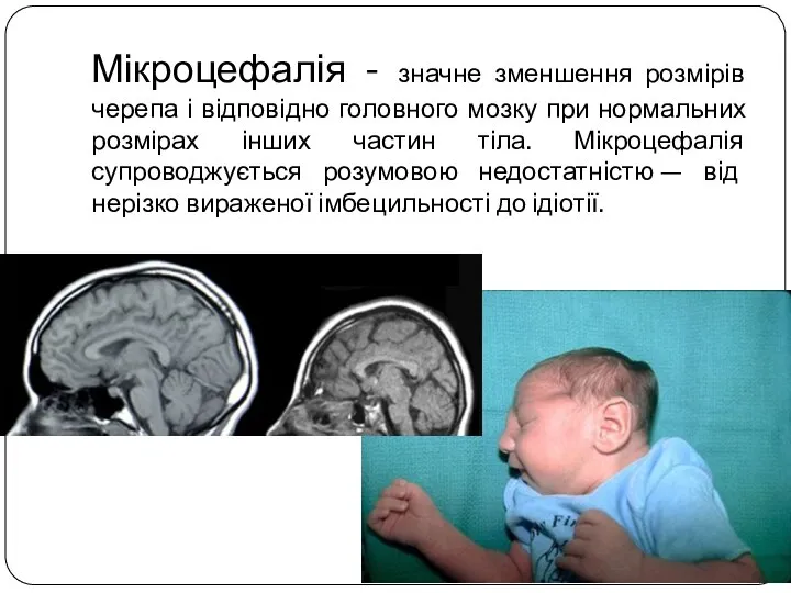 Мікроцефалія - значне зменшення розмірів черепа і відповідно головного мозку при нормальних