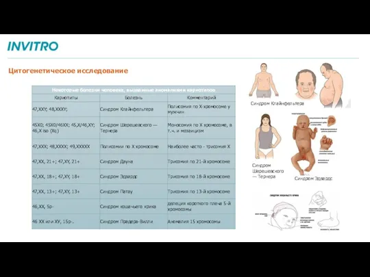 Цитогенетическое исследование Синдром Клайнфельтера Синдром Шерешевского — Тернера Синдром Эдвардс