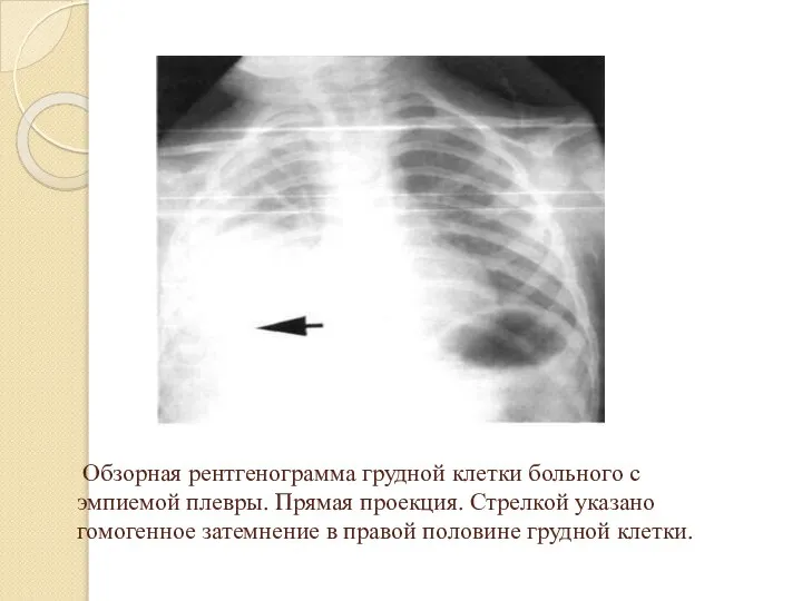 Обзорная рентгенограмма грудной клетки больного с эмпиемой плевры. Прямая проекция. Стрелкой указано