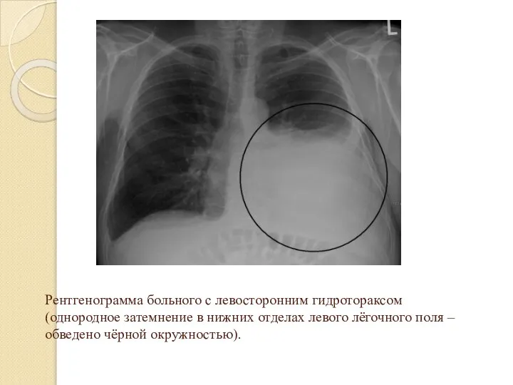 Рентгенограмма больного с левосторонним гидротораксом (однородное затемнение в нижних отделах левого лёгочного