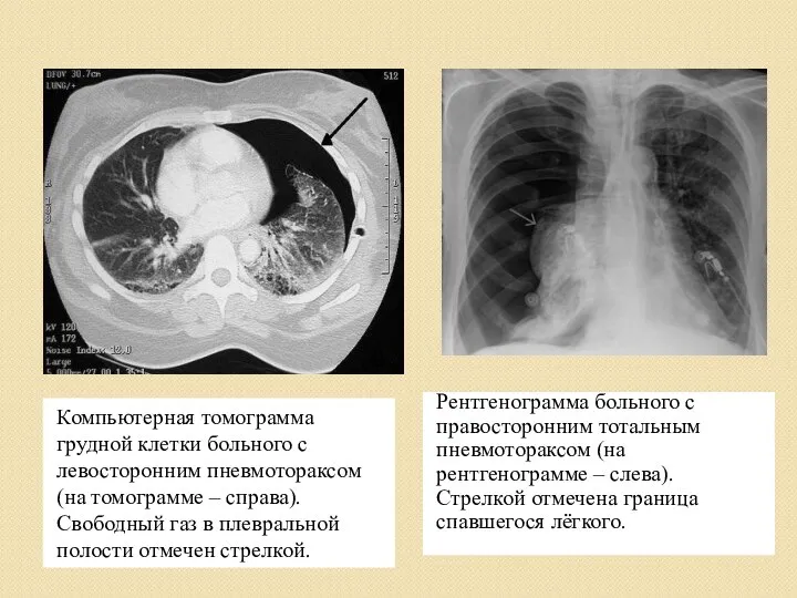 Компьютерная томограмма грудной клетки больного с левосторонним пневмотораксом (на томограмме – справа).