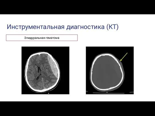 Инструментальная диагностика (КТ) Эпидуральная гематома