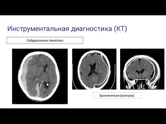 Инструментальная диагностика (КТ) Субдуральная гематома Хроническая (капсула)