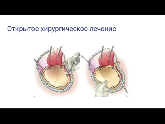 Открытое хирургическое лечение