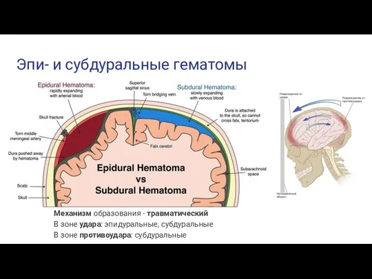 Эпи- и субдуральные гематомы Механизм образования - травматический В зоне удара: эпидуральные,