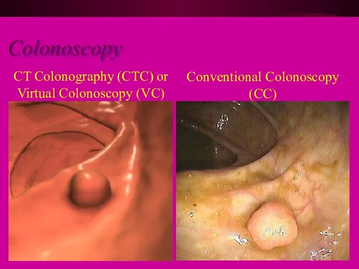 o Colonoscopy CT Colonography (CTC) or Virtual Colonoscopy (VC) Conventional Colonoscopy (CC)