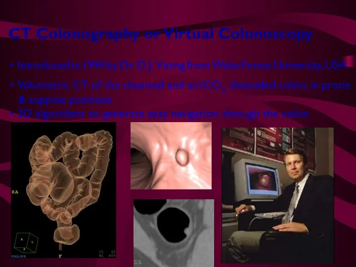 CT Colonography or Virtual Colonoscopy Introduced in 1994 by Dr. D. J.