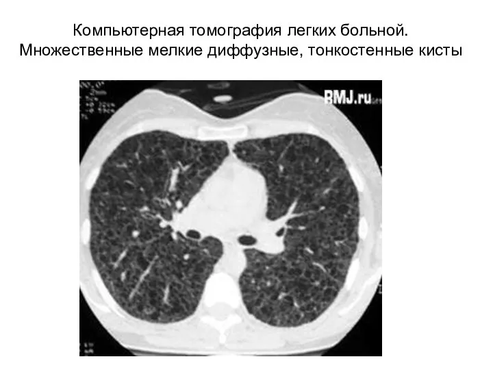 Компьютерная томография легких больной. Множественные мелкие диффузные, тонкостенные кисты