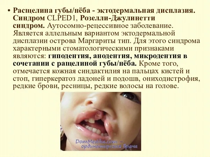 Расщелина губы/нёба - эктодермальная дисплазия. Синдром CLPED1, Розелли-Джулинетти синдром. Аутосомно-рецессивное заболевание. Является