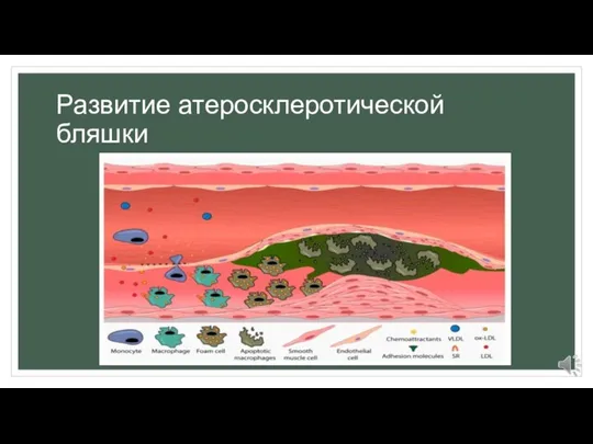 Развитие атеросклеротической бляшки