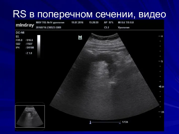 RS в поперечном сечении, видео