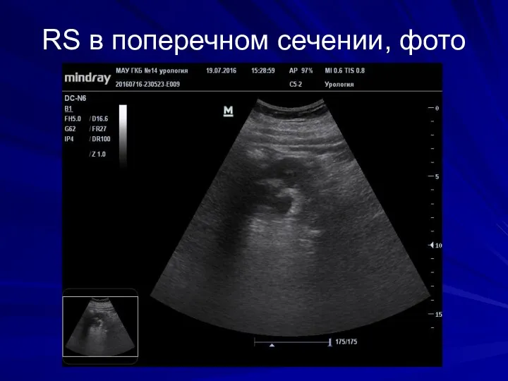 RS в поперечном сечении, фото