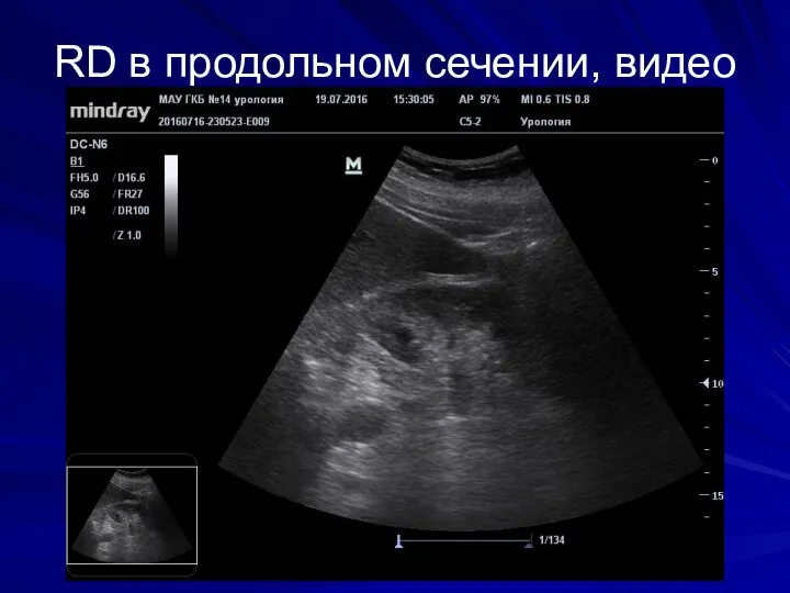 RD в продольном сечении, видео