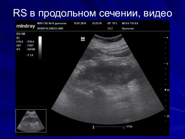 RS в продольном сечении, видео