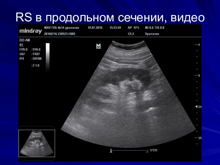 RS в продольном сечении, видео